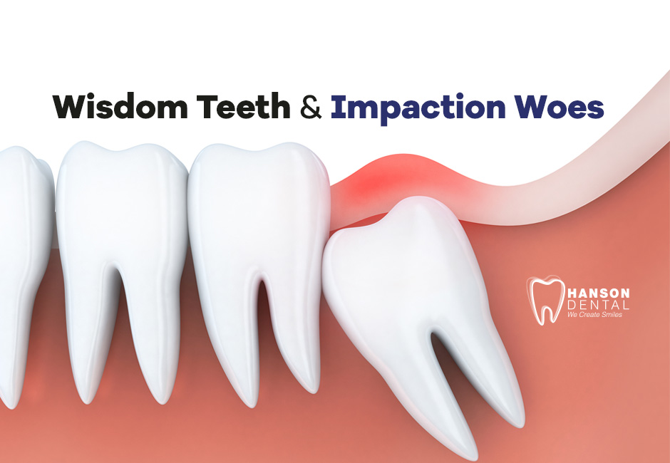 Wisdom Teeth & Impaction Woes