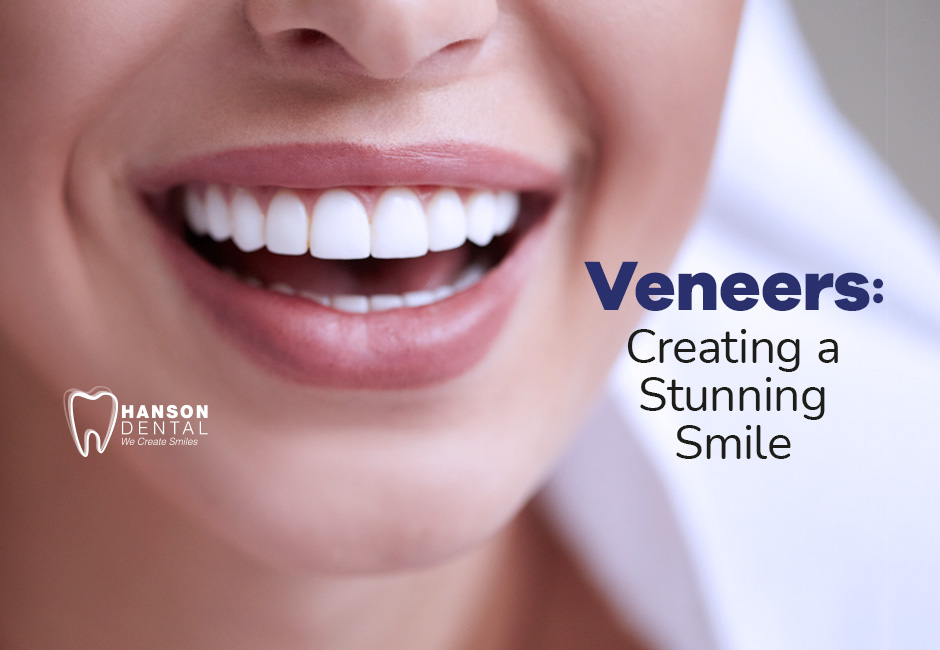 Veneers: Creating a Stunning Smile