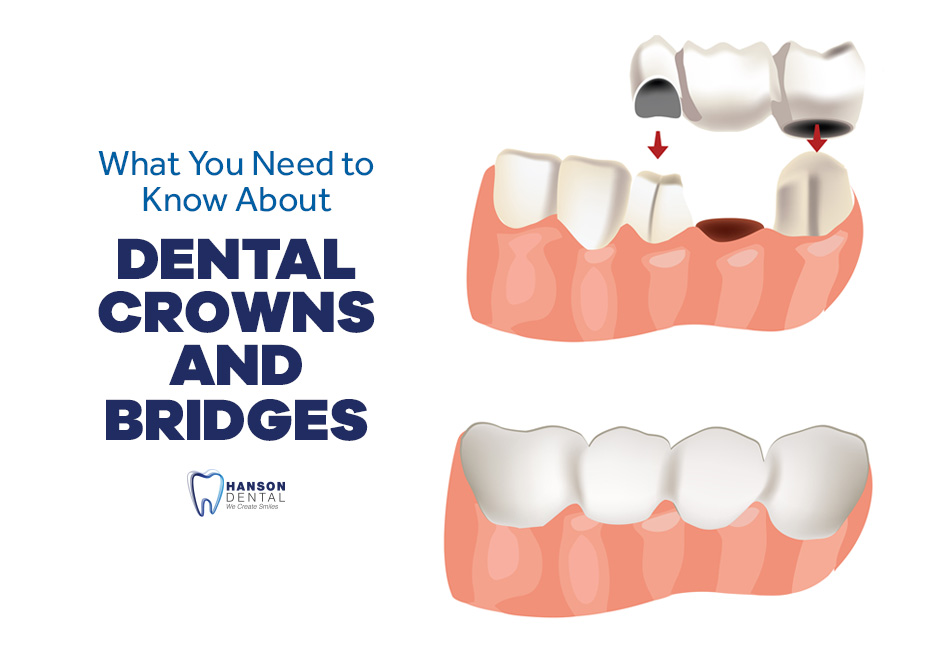 What You Need to Know About Dental Crowns and Bridges