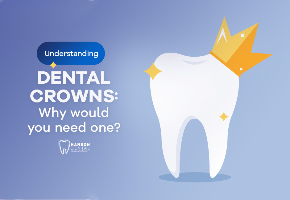 Understanding dental crowns: Why would you need one?
