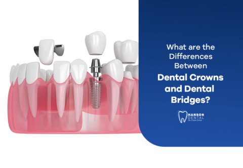What are the Differences Between Dental Crowns and Dental Bridges ...