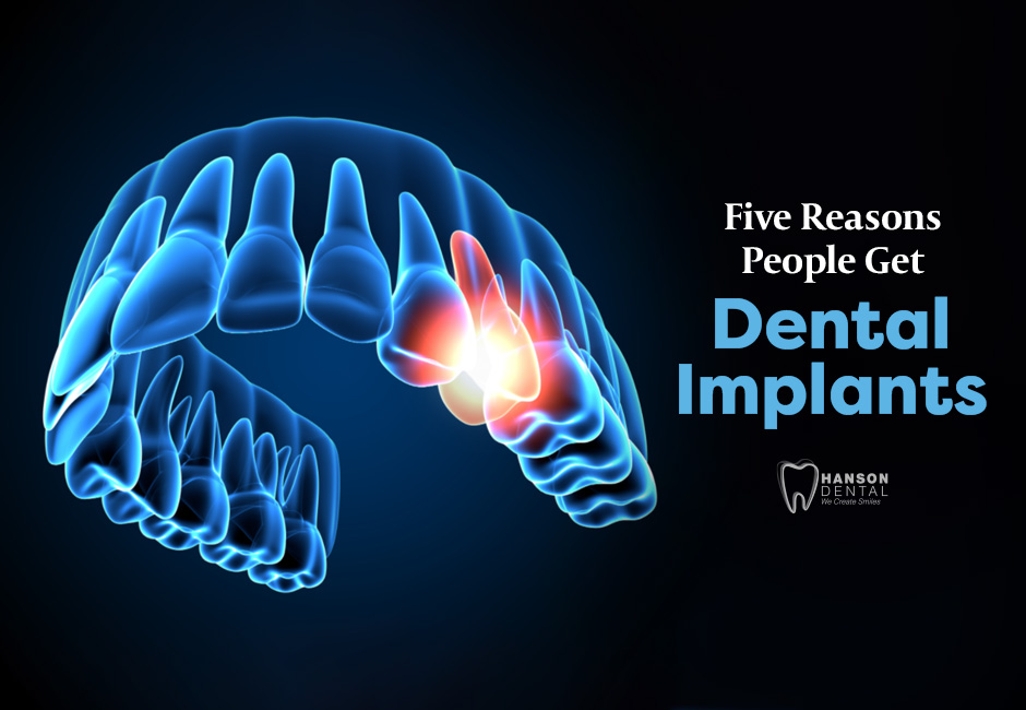 Five Reasons People Get Dental Implants