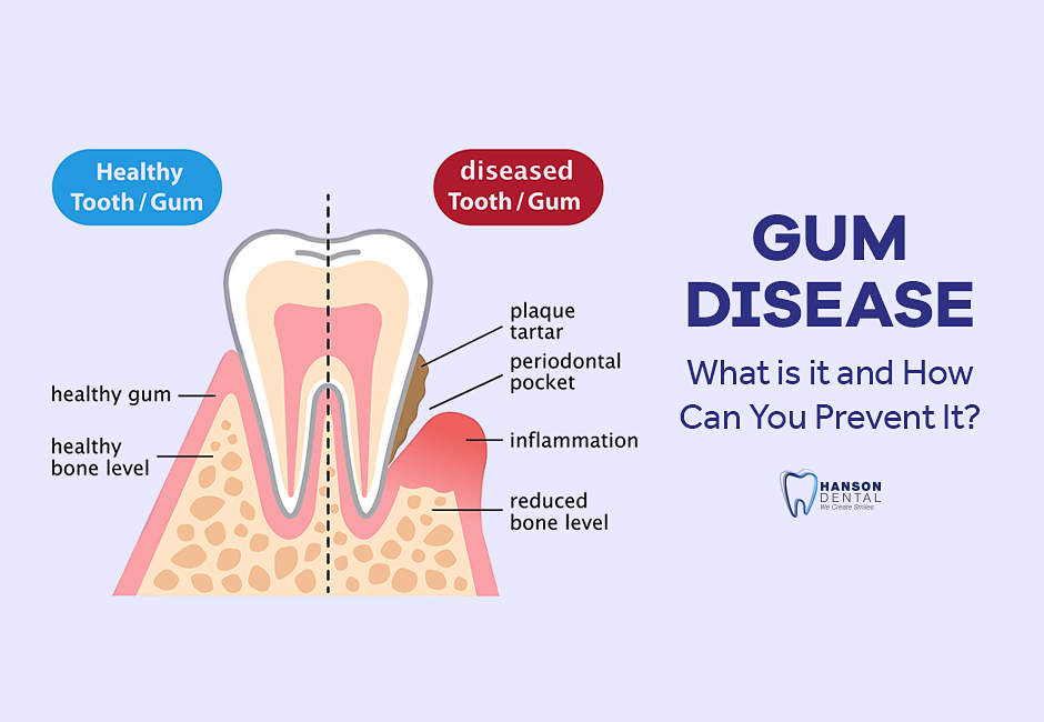 Gum Disease – What is it and How Can You Prevent It?